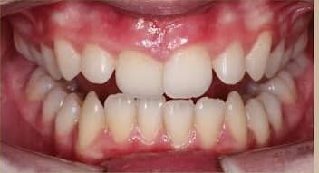 Orthodontie — Avant