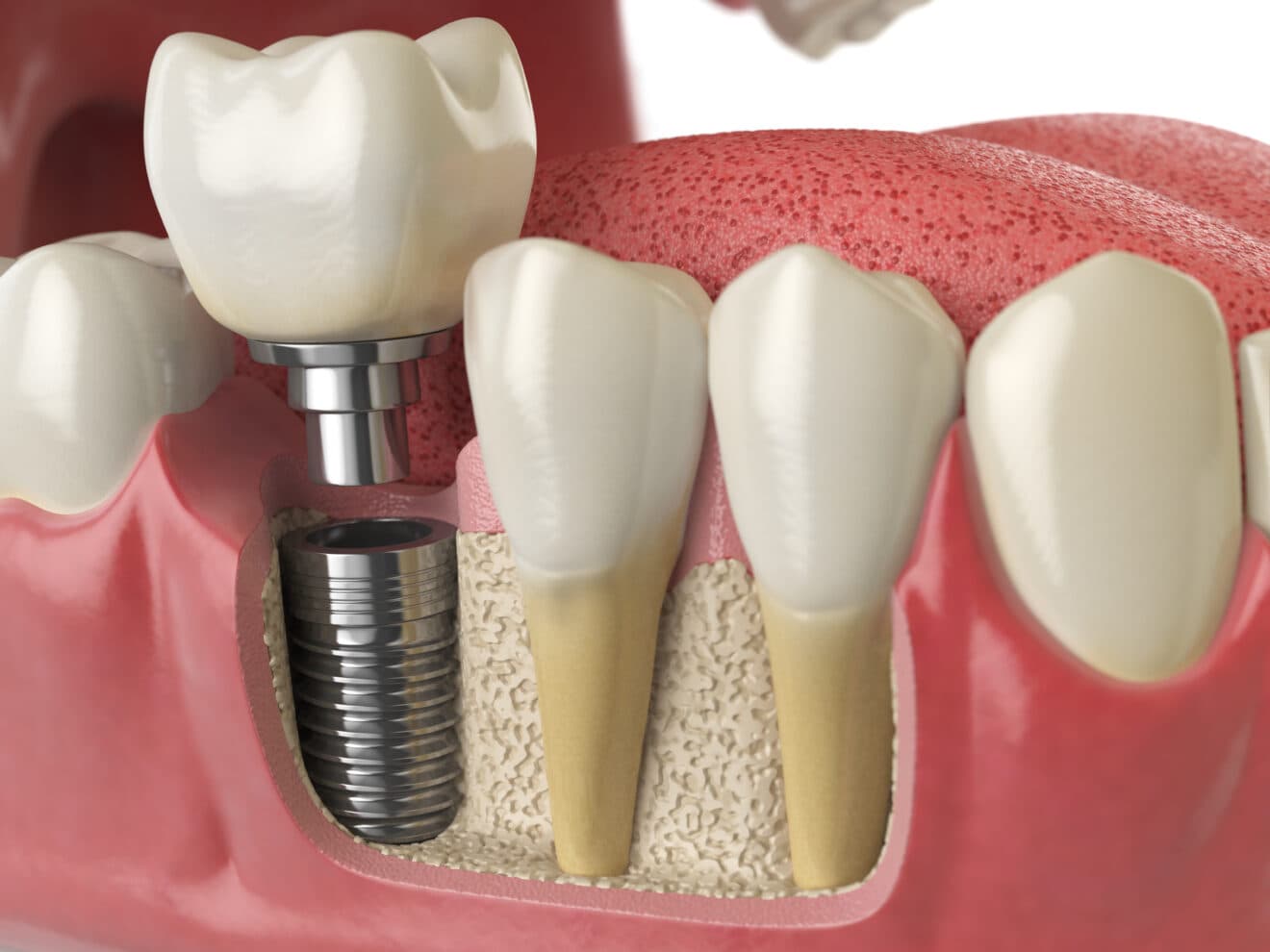 Implants dentaires — Centre El Mostaine Dental